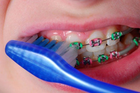 طريقة تفريش الاسنان بالتقويم